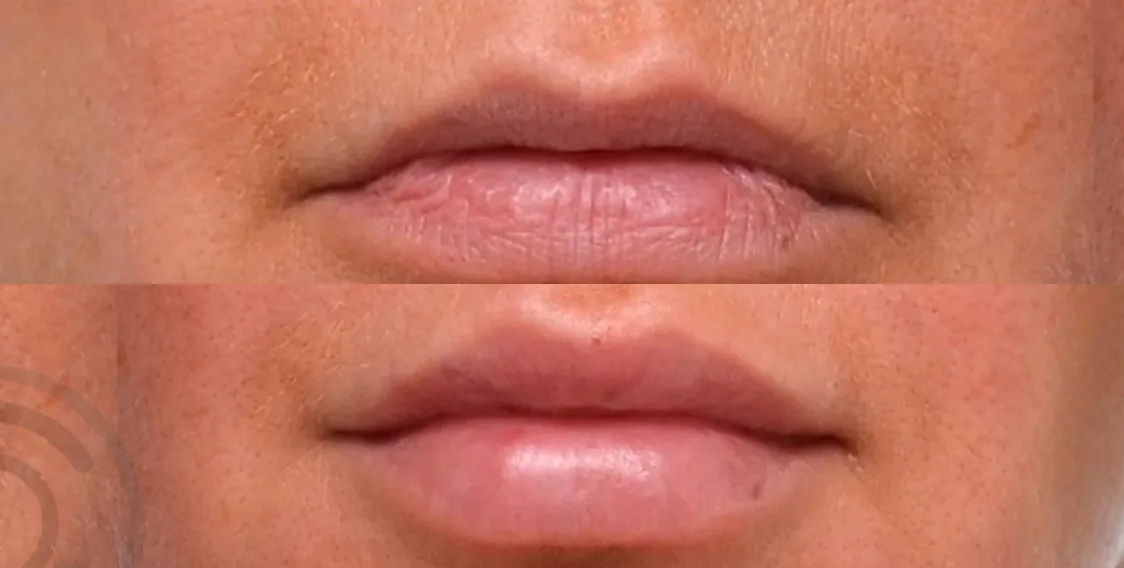 Lip Filler